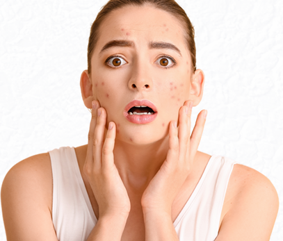 Anti Acne